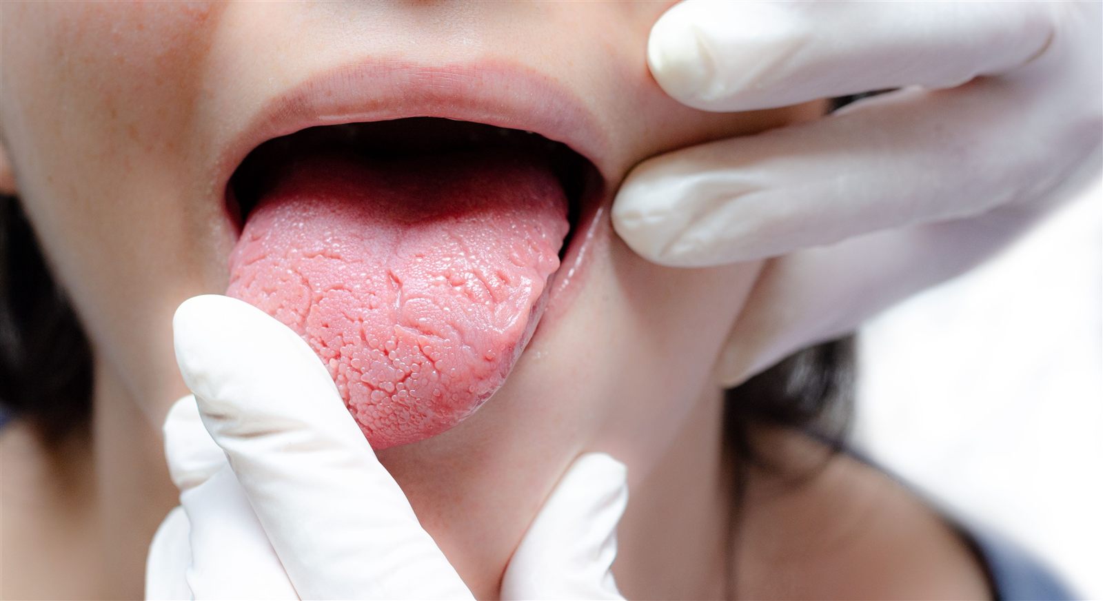 Close-up of a tongue being examined by a clinician wearing gloves
